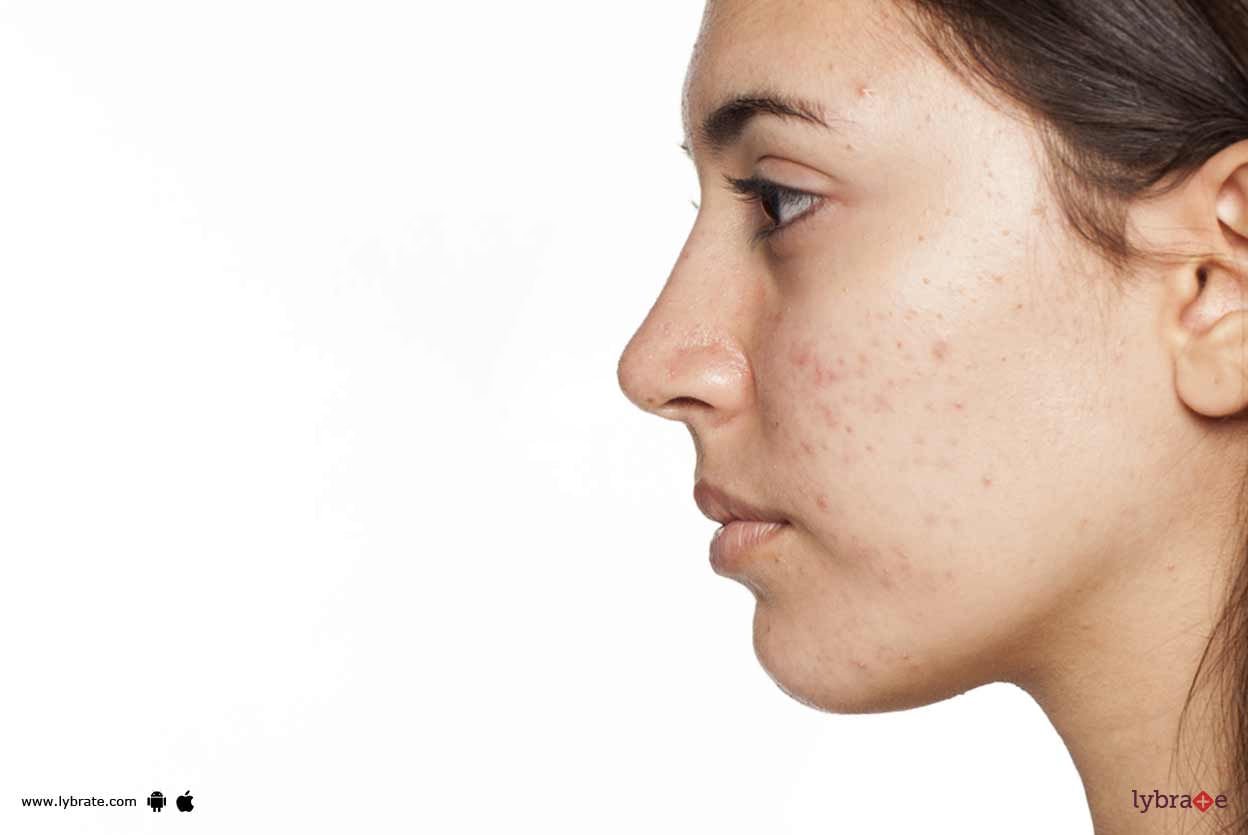 Acne/Pimples - How Effective Is Homeopathy In Them?