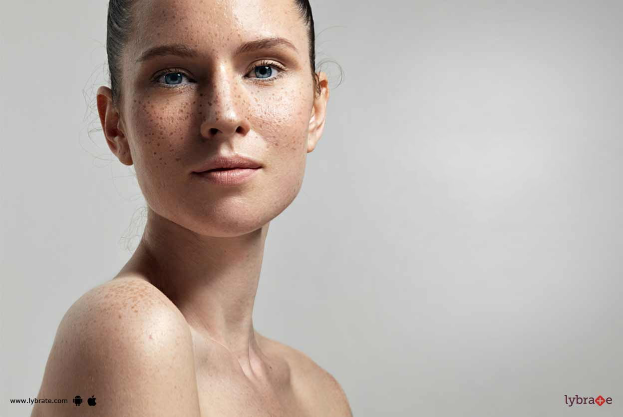 Melasma -  Know More About It!
