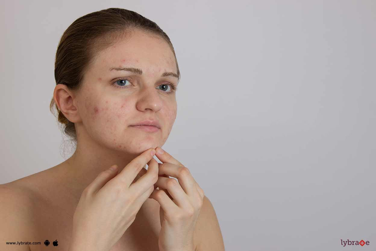 Causes & Treatments Of Acne Scars!