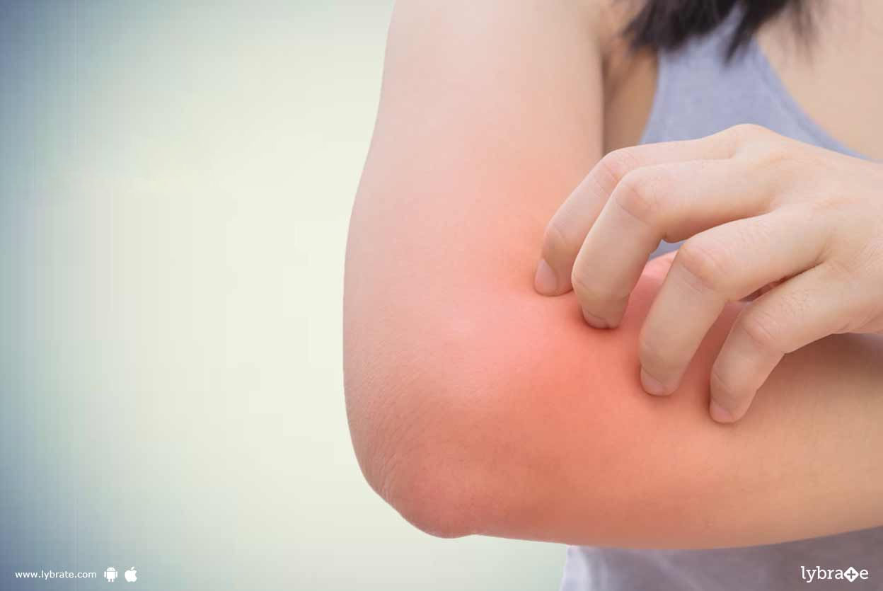 Contact Dermatitis - What Are The Symptoms Of It?