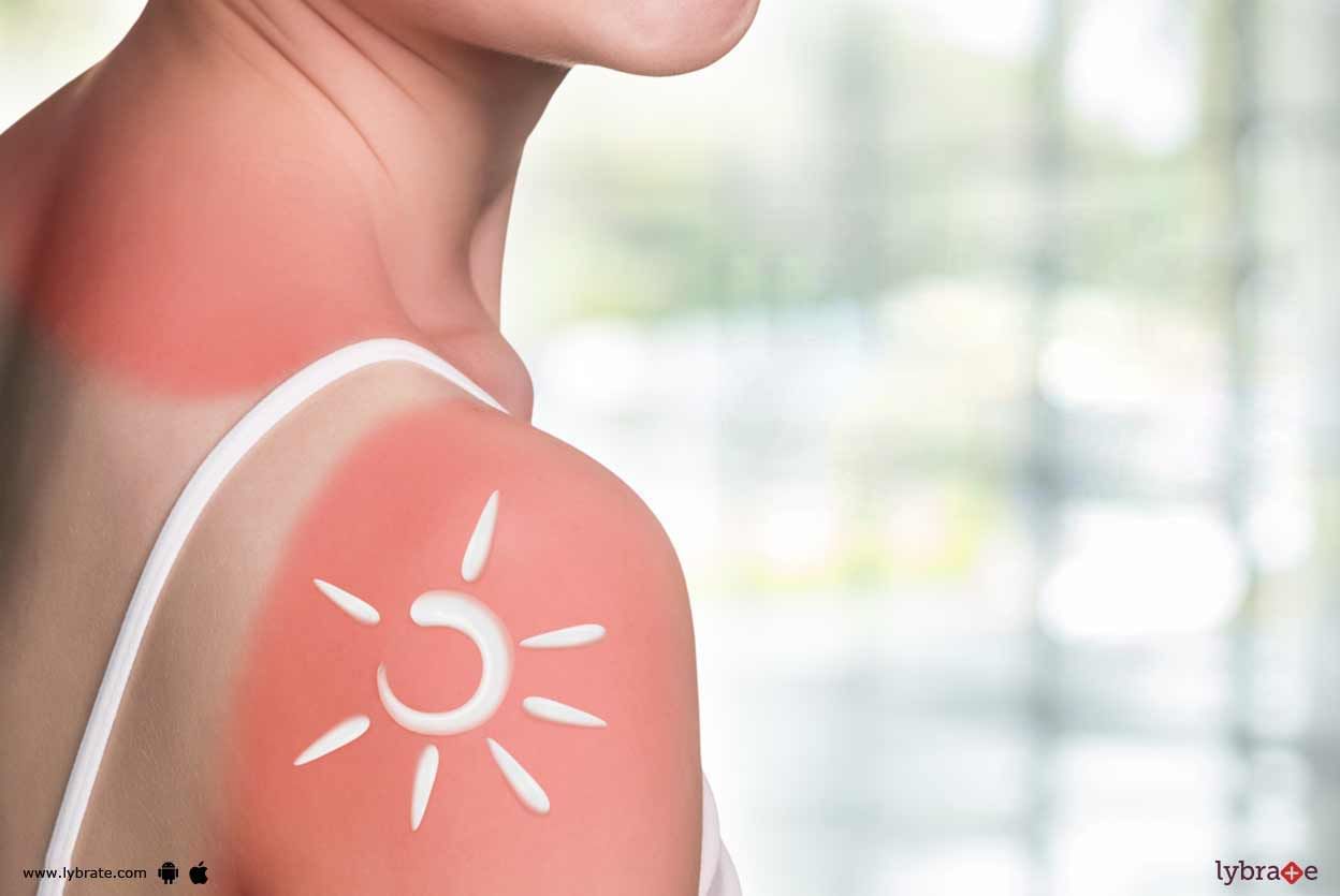 How To Soothe A Sunburn?