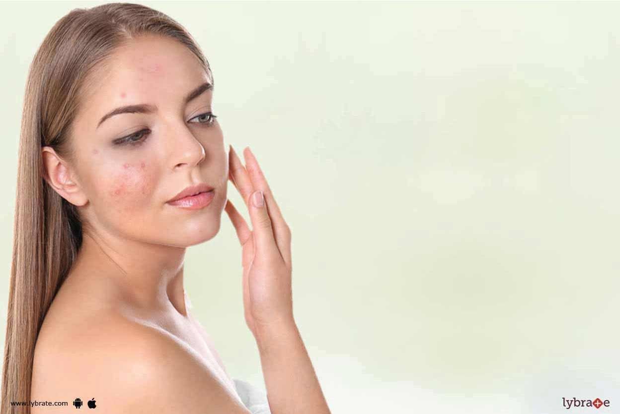 Melasma - How To Administer It?