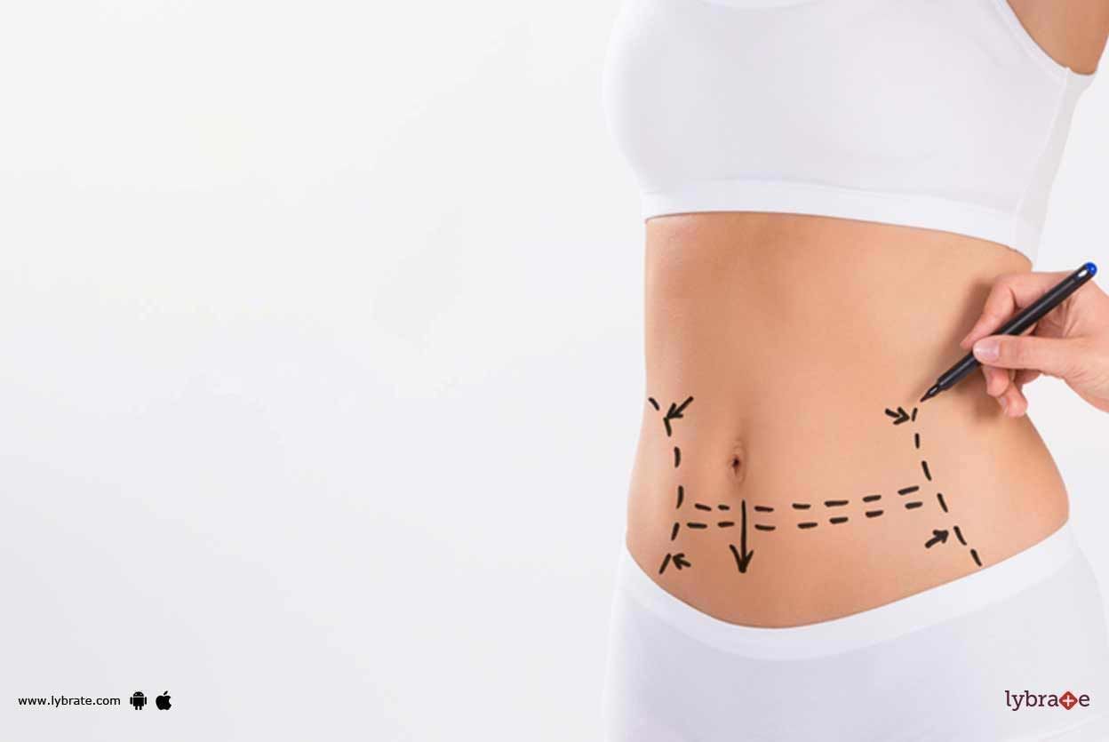 Liposuction - What Should You Know?