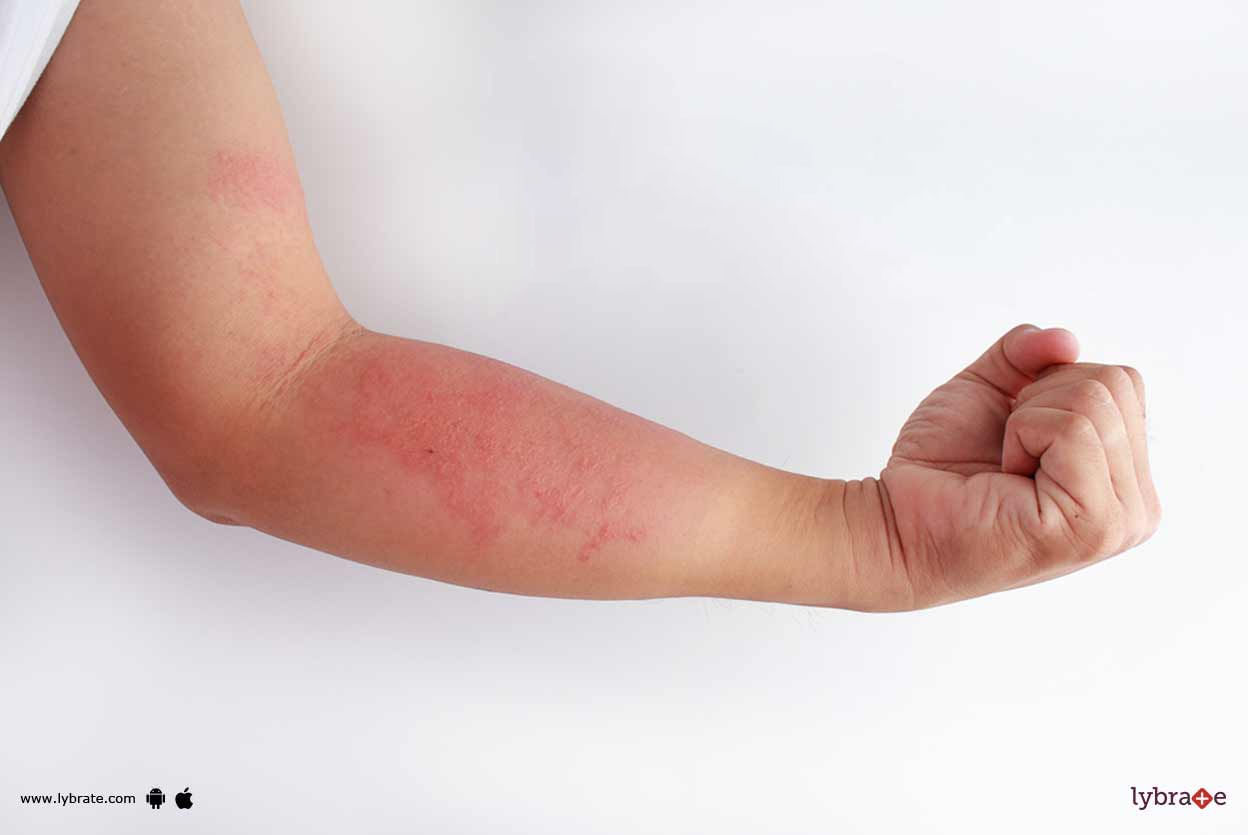 Role Of Homeopathy In Treating Eczema!