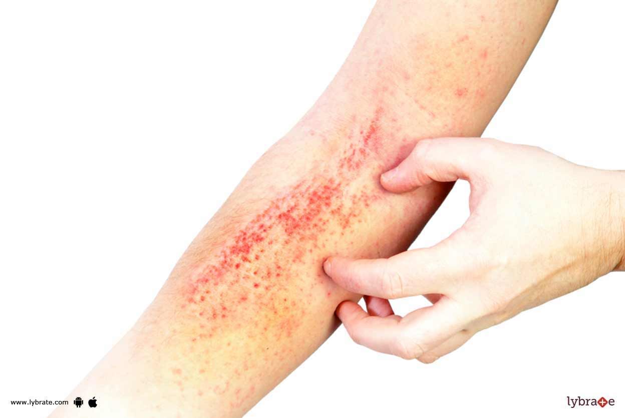 Protein Contact Dermatitis - How To Administer It?