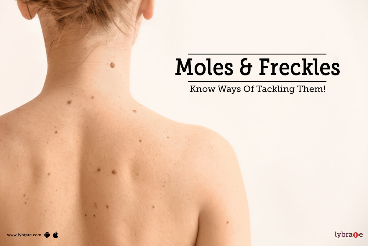Moles & Freckles - Know Ways Of Tackling Them!