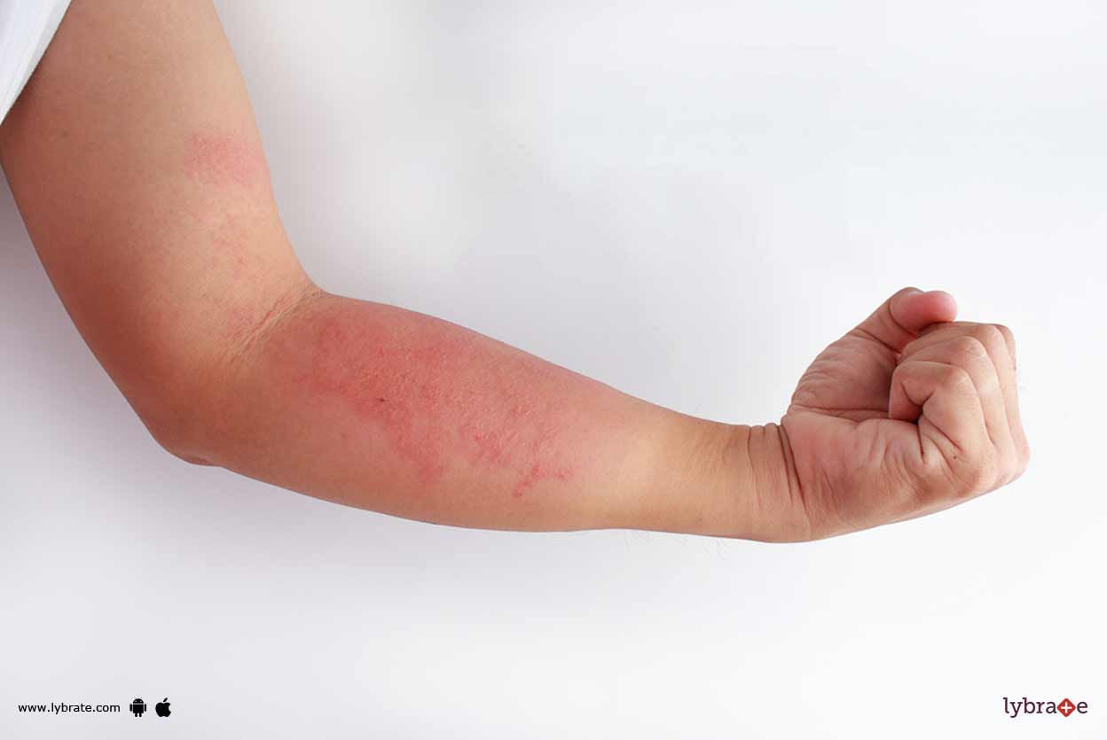 Eczema - How You Can Prevent Its Flare-ups?