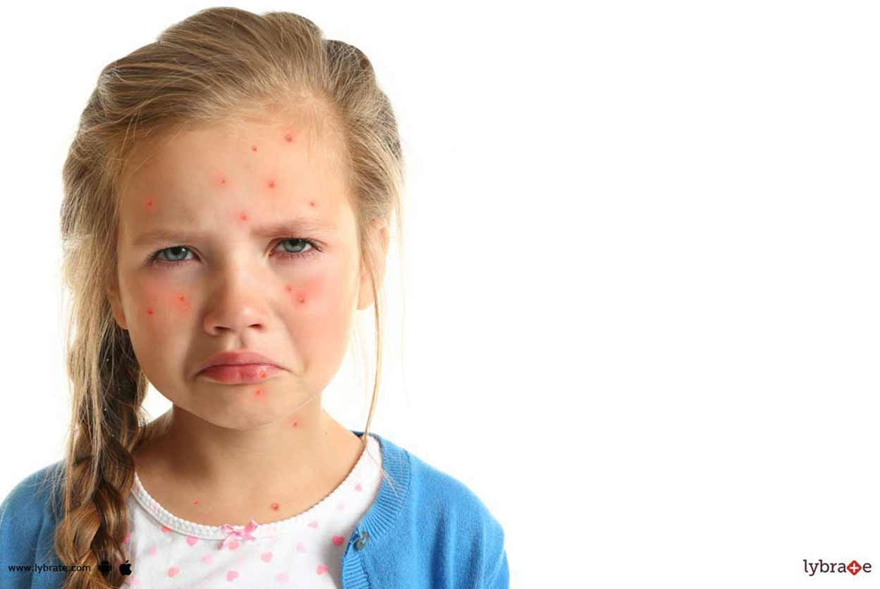 Chicken Pox - How To Handle It Well?
