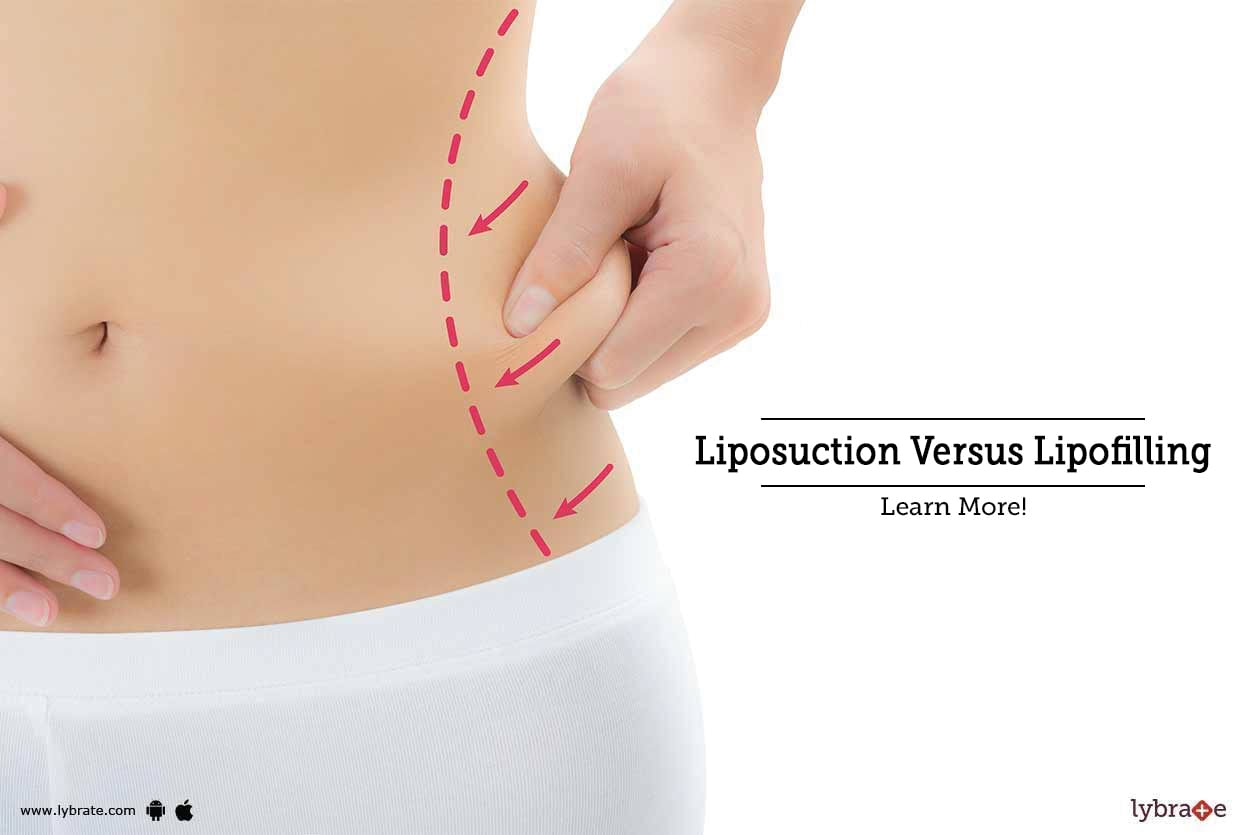Liposuction Versus Lipofilling - Learn More!