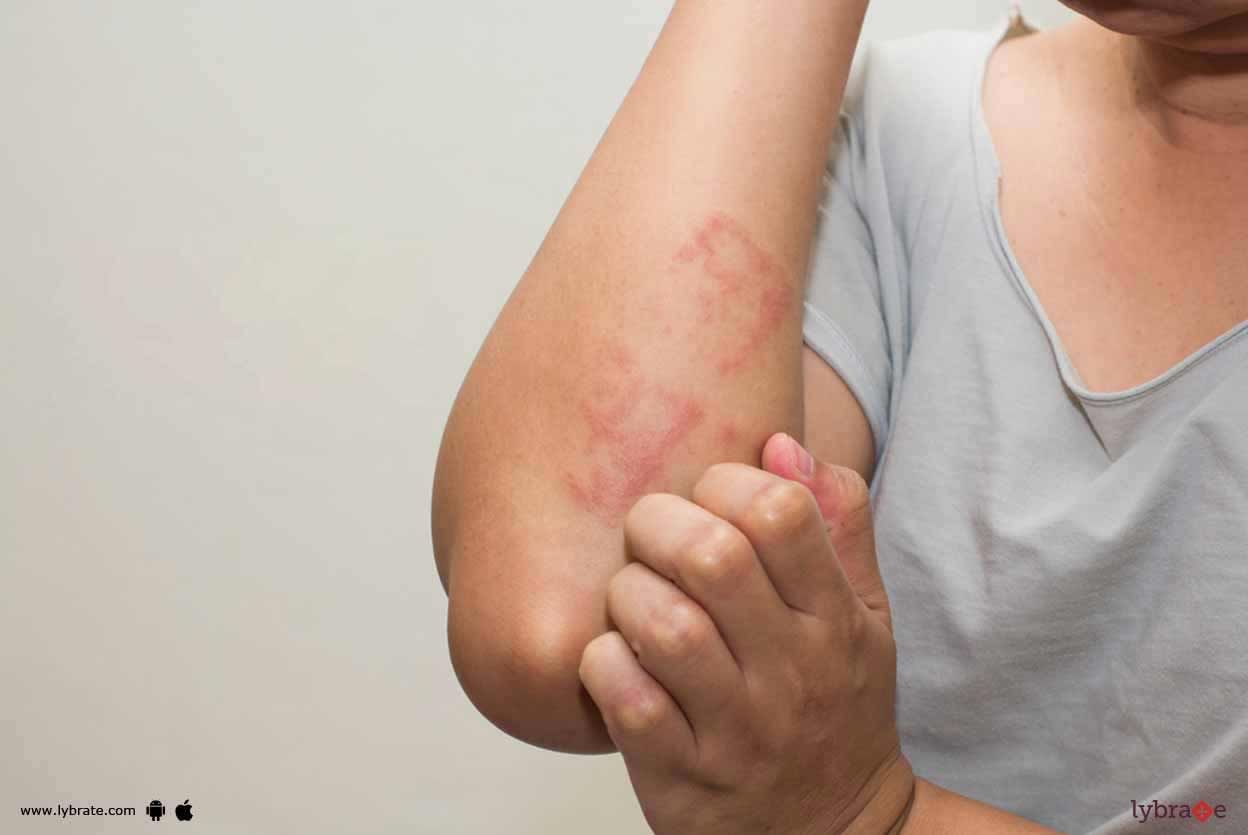 Psoriasis - All About Its Symptoms And Causes!
