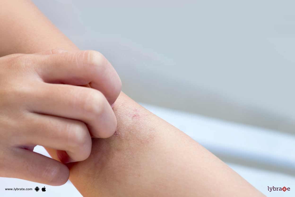 Scabies - What Should You Know?