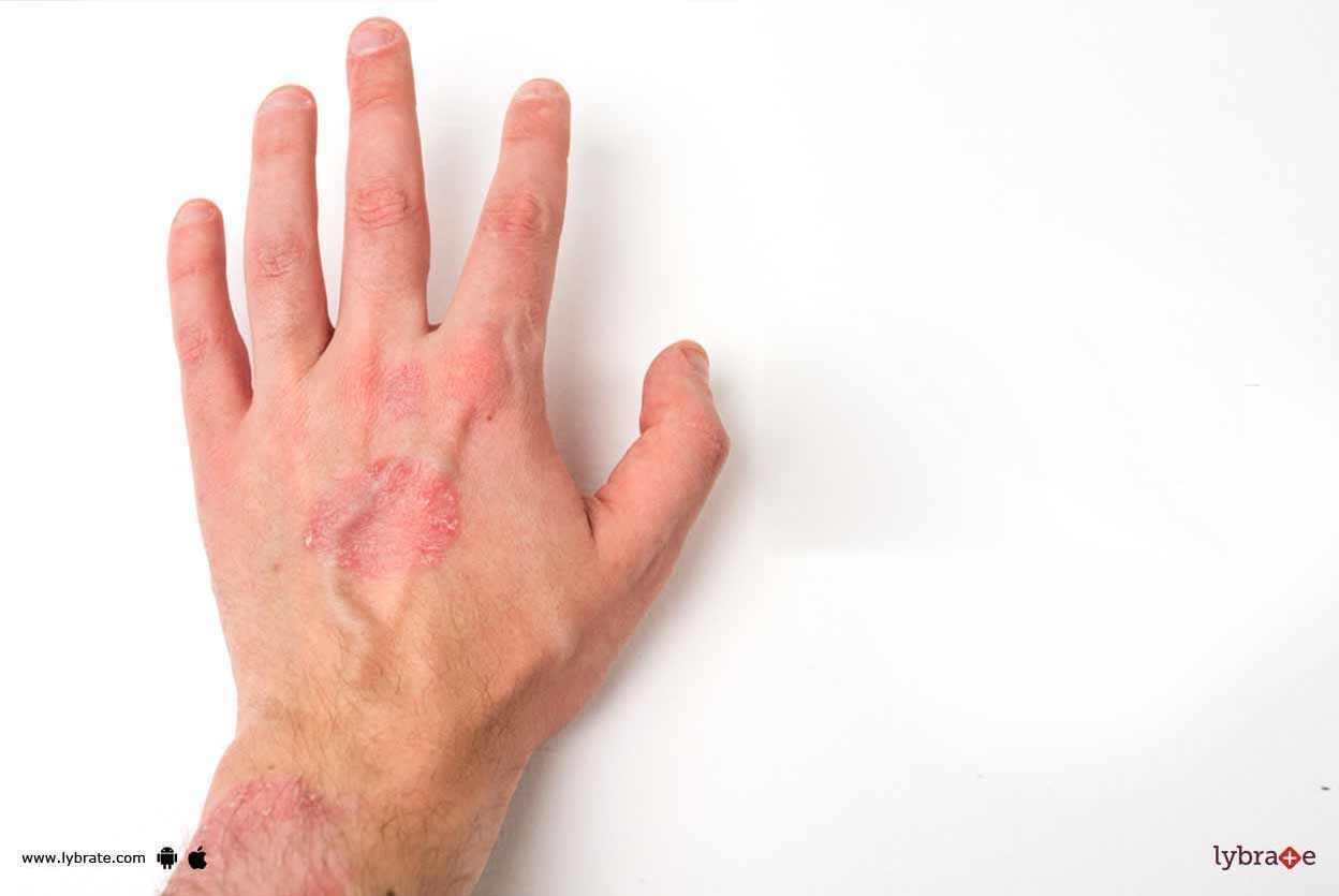 Narrow Band UVB Therapy - How Can It Treat Skin Problems?