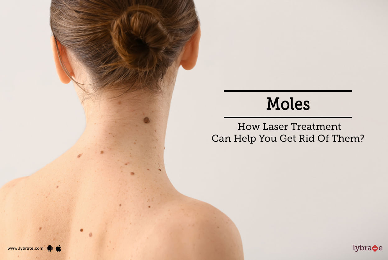 Moles - How Laser Treatment Can Help You Get Rid Of Them?