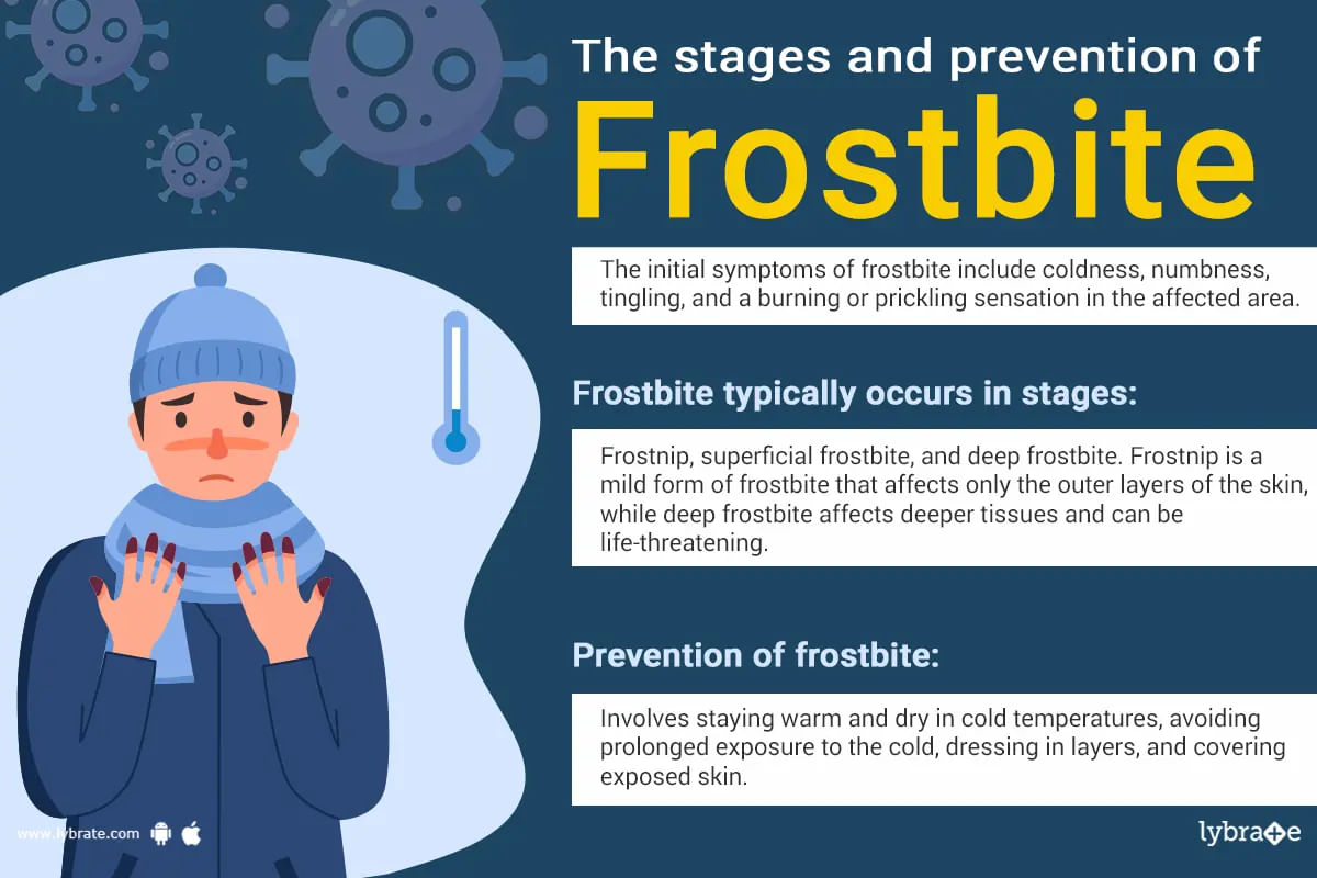 Frostbite: Symptoms, Stages and Prevention