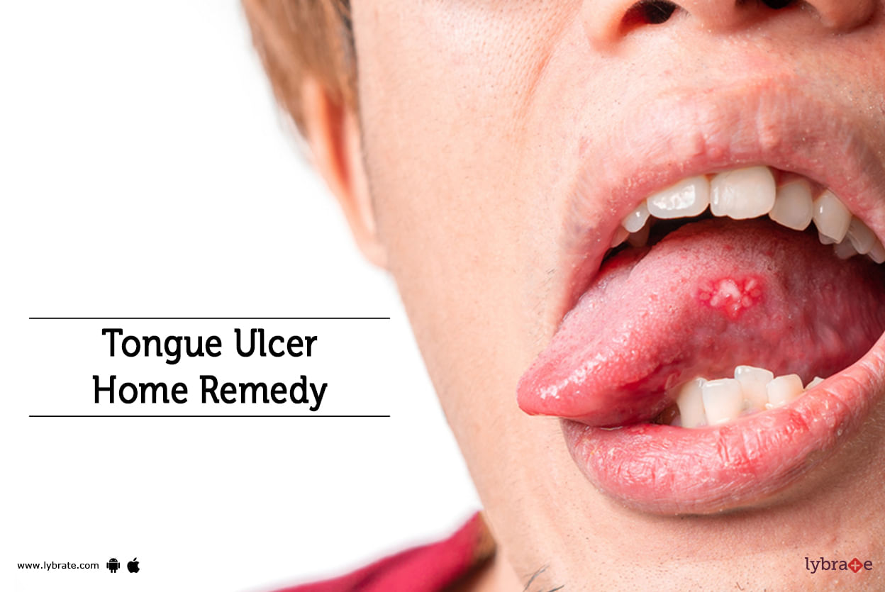 Tongue Ulcer Home Remedy