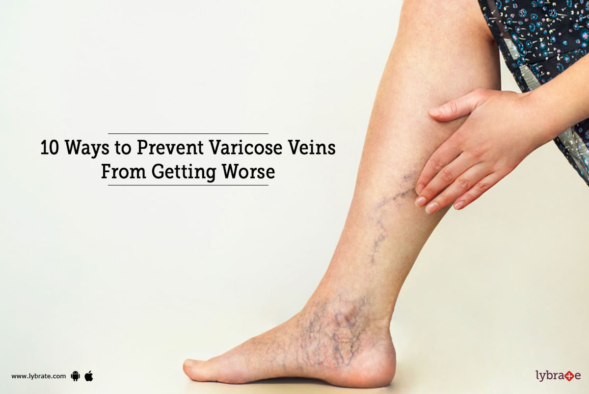 10 Ways to Prevent Varicose Veins From Getting Worse