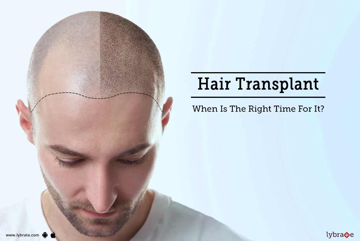 Hair Transplant - When Is The Right Time For It?