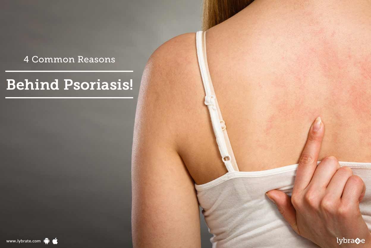 4 Common Reasons Behind Psoriasis!