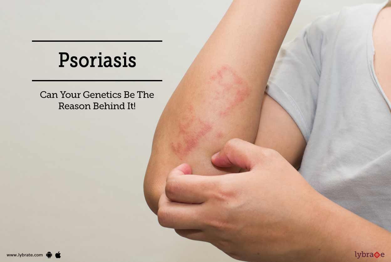 Psoriasis - Can Your Genetics Be The Reason Behind It!