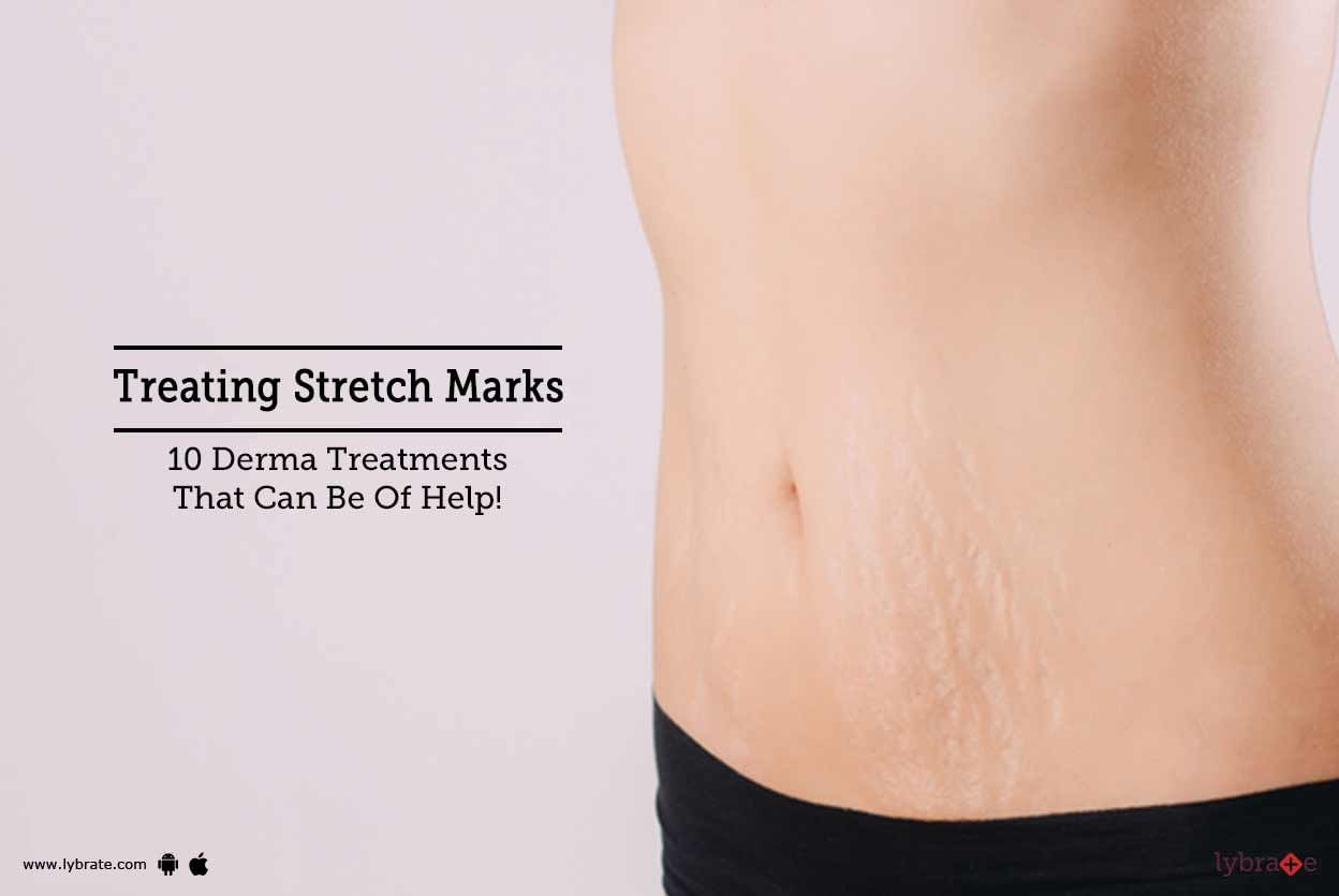 Treating Stretch Marks - 10 Derma Treatments That Can Be Of Help!
