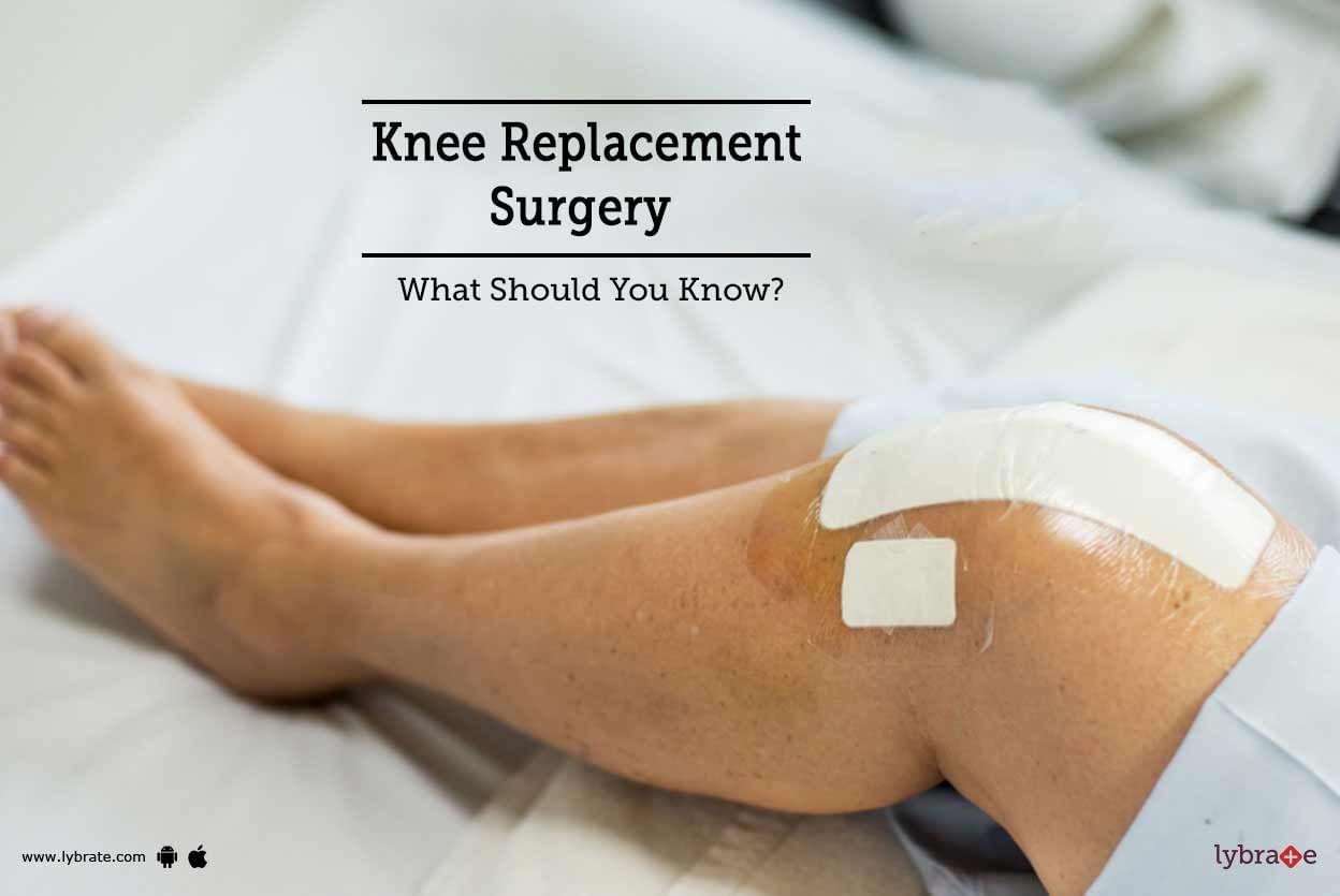 Knee Replacement Surgery - What Should You Know?