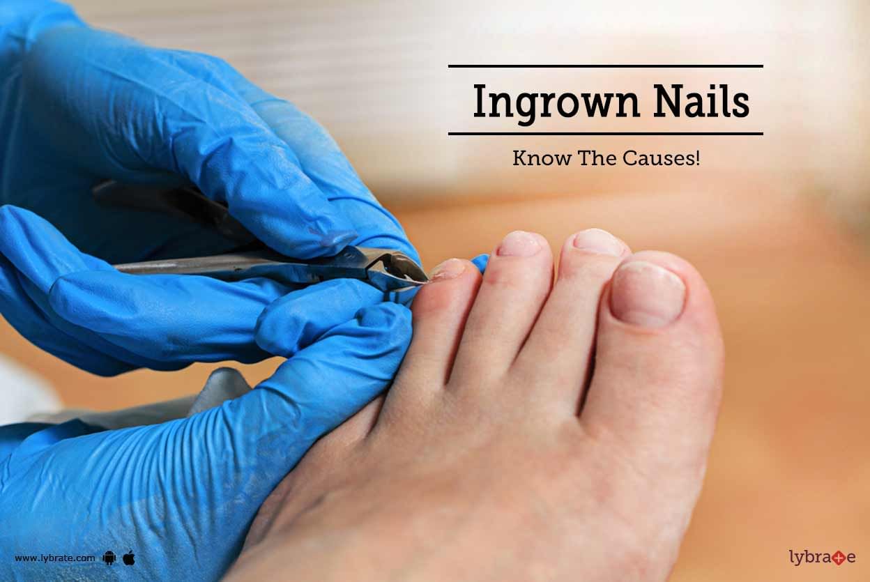 Ingrown Nails - Know The Causes!