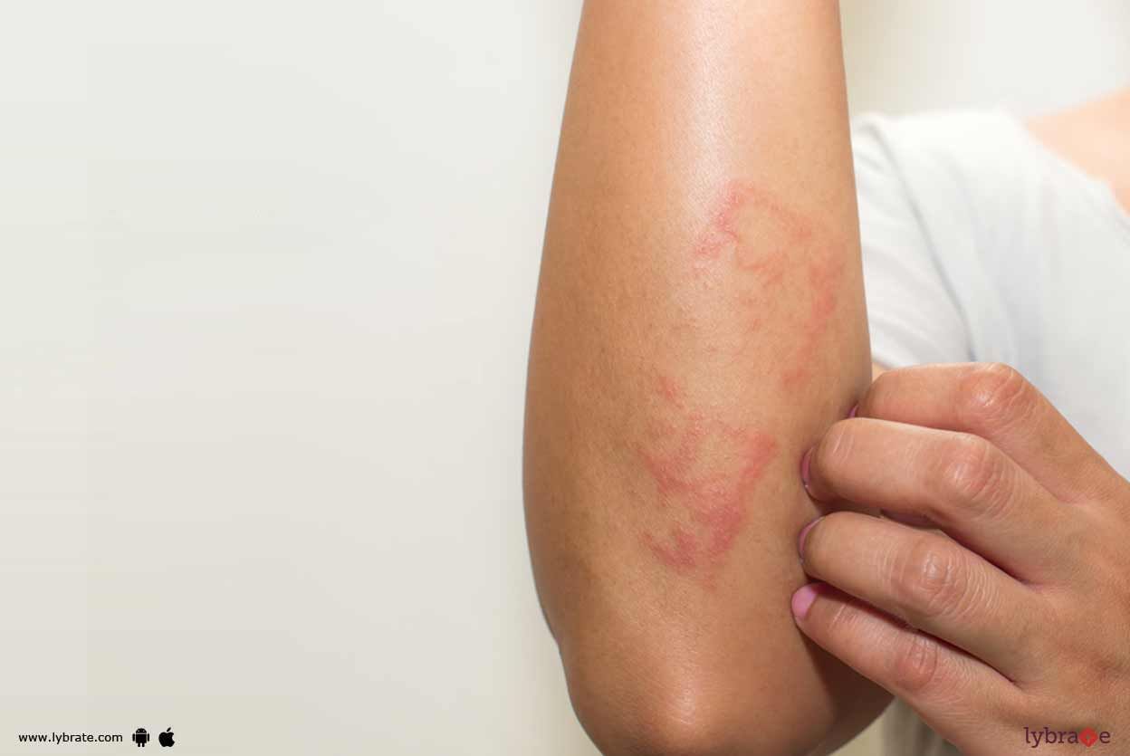 Contact Dermatitis - Know Forms Of It!