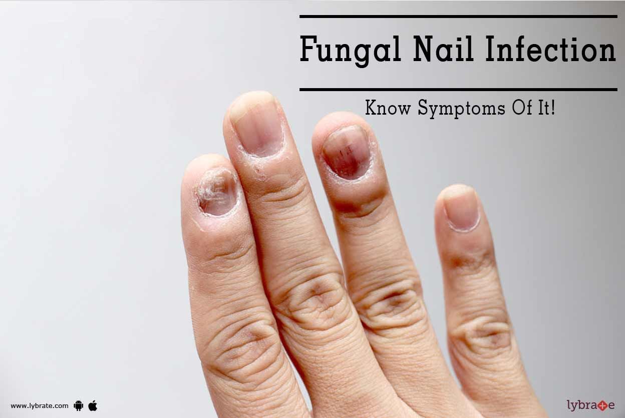 Fungal Nail Infection - Know Symptoms Of It!