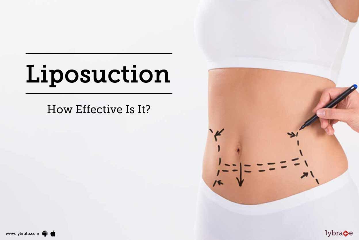 Liposuction - How Effective Is It?
