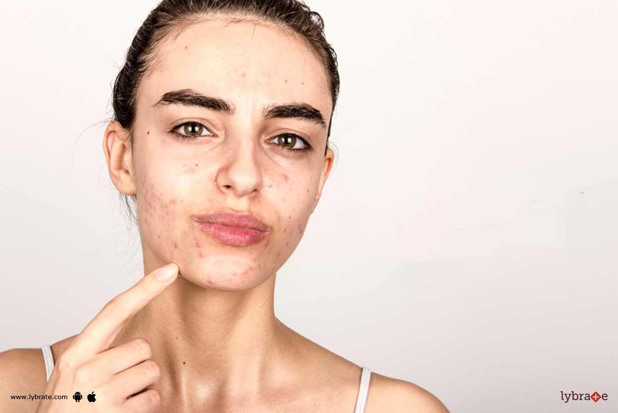 Acne & Breakouts - How To Avert Them?
