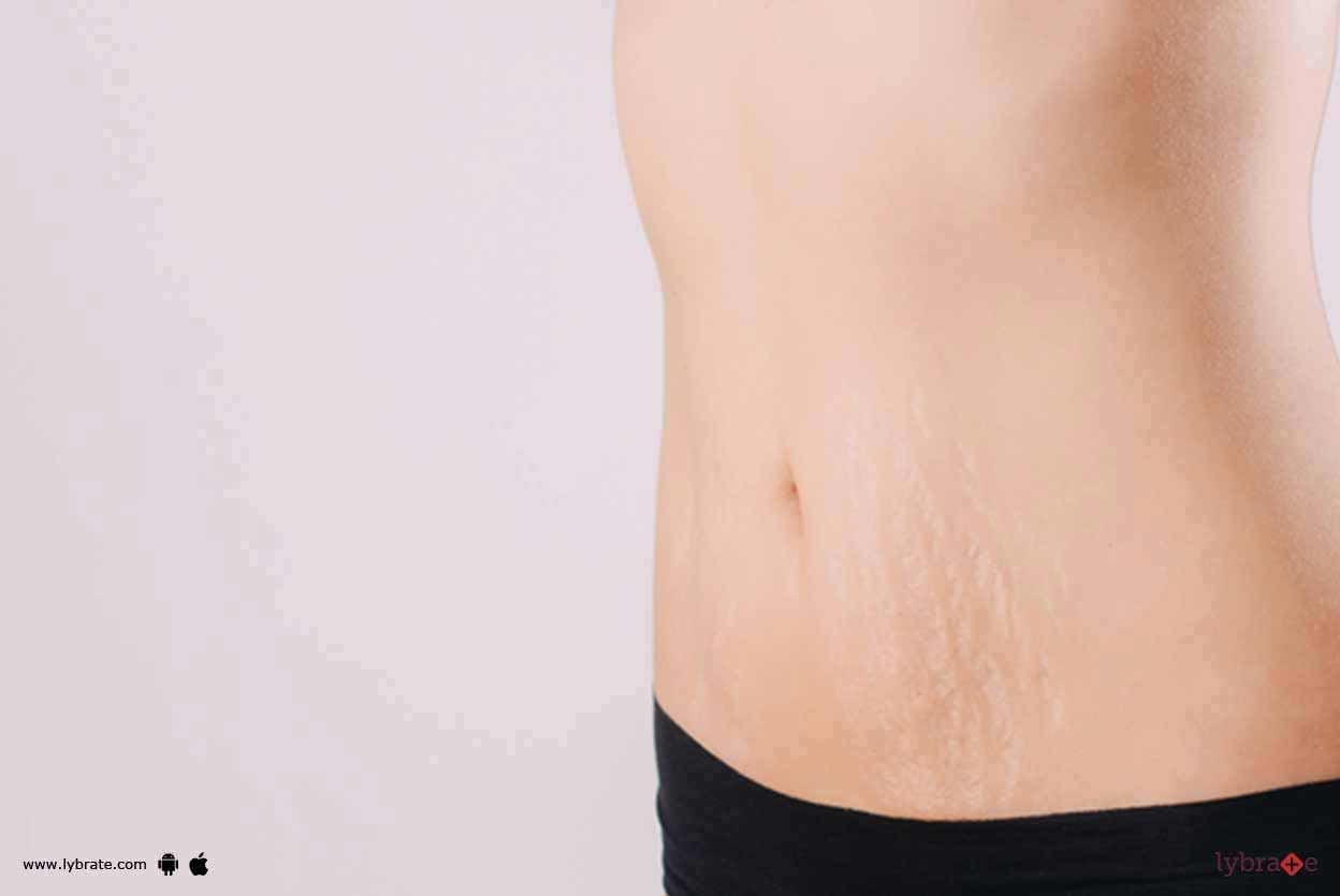 Post Pregnancy Stretchmarks - Know How To Treat Them Without Surgery!