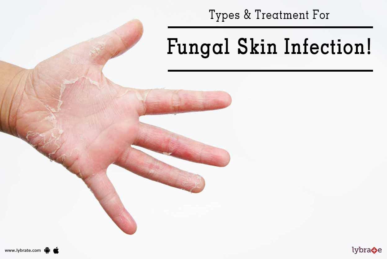 Types & Treatment For Fungal Skin Infection!