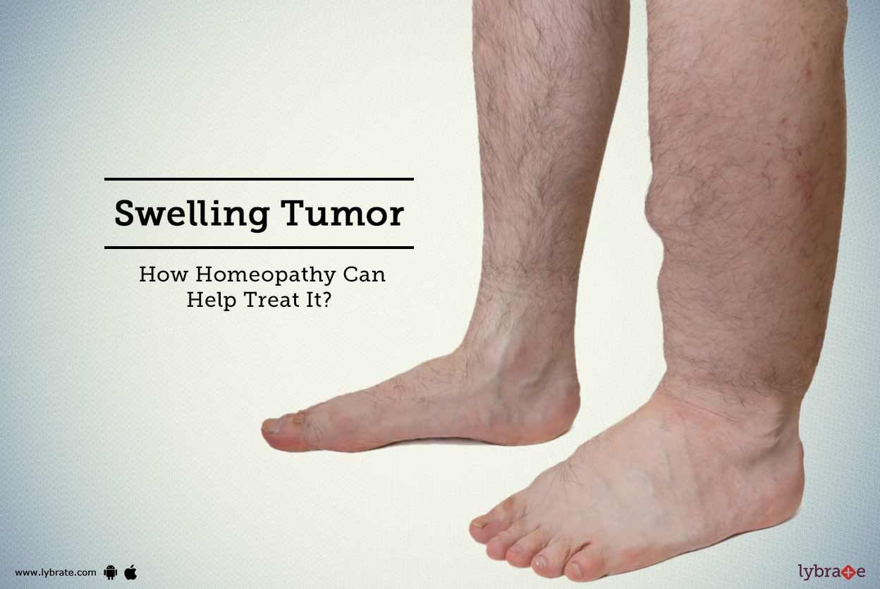 Swelling Tumor - How Homeopathy Can Help Treat It?