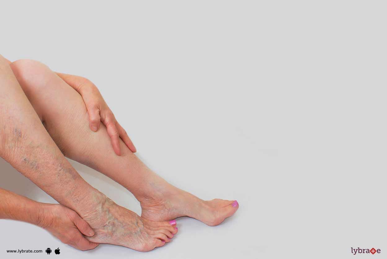 In Detail About Varicose Vein & Its Treatment!
