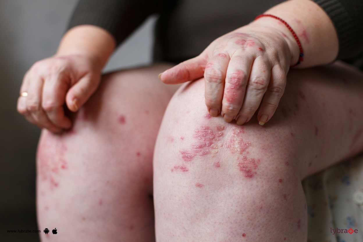 Psoriasis - An Ayurveda Approach To Deal With It!