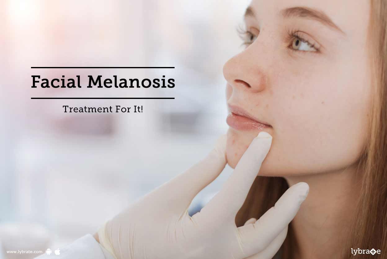 Facial Melanosis - Treatment For It!