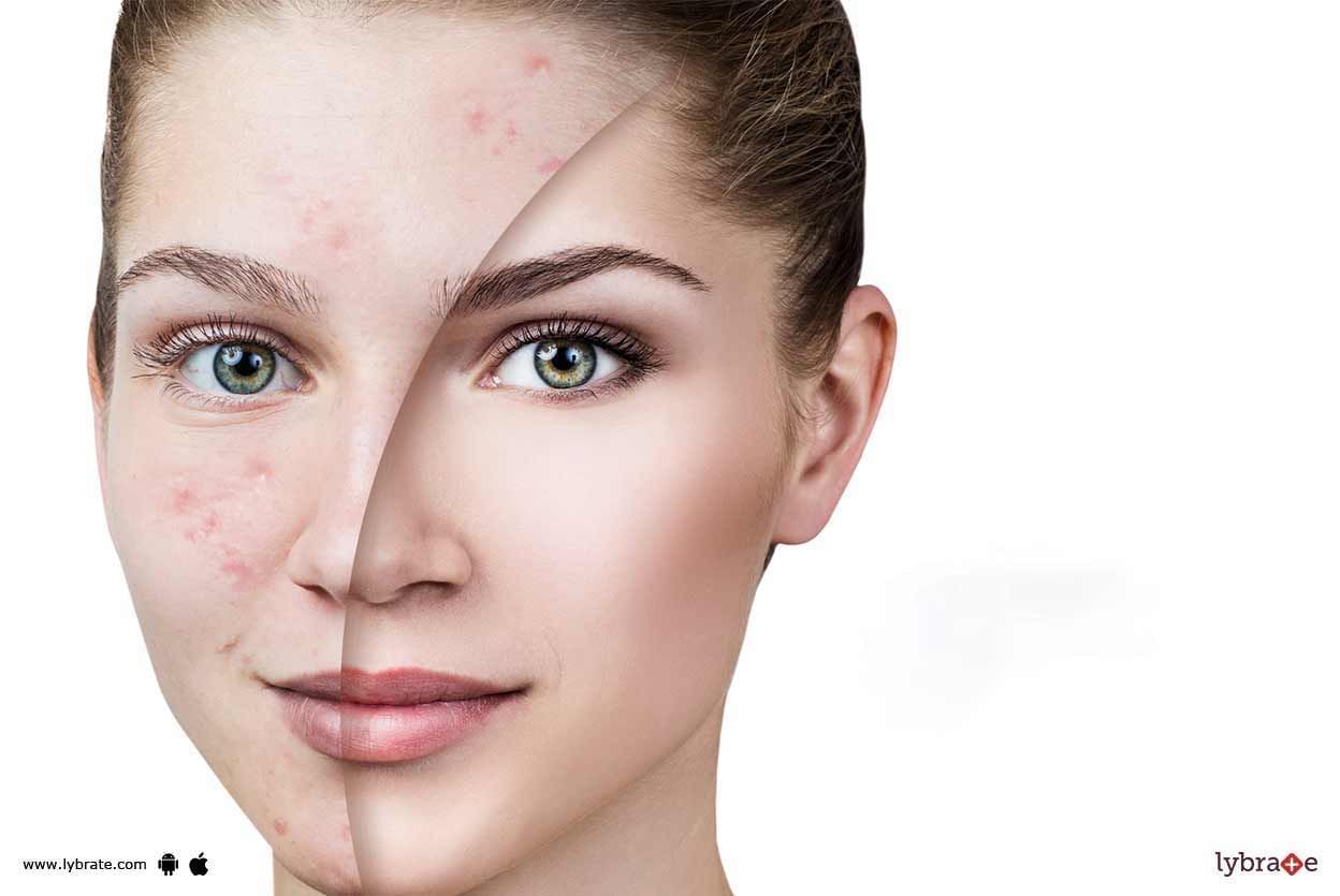 Acne & Its Scars - Know How To Deal With Them!