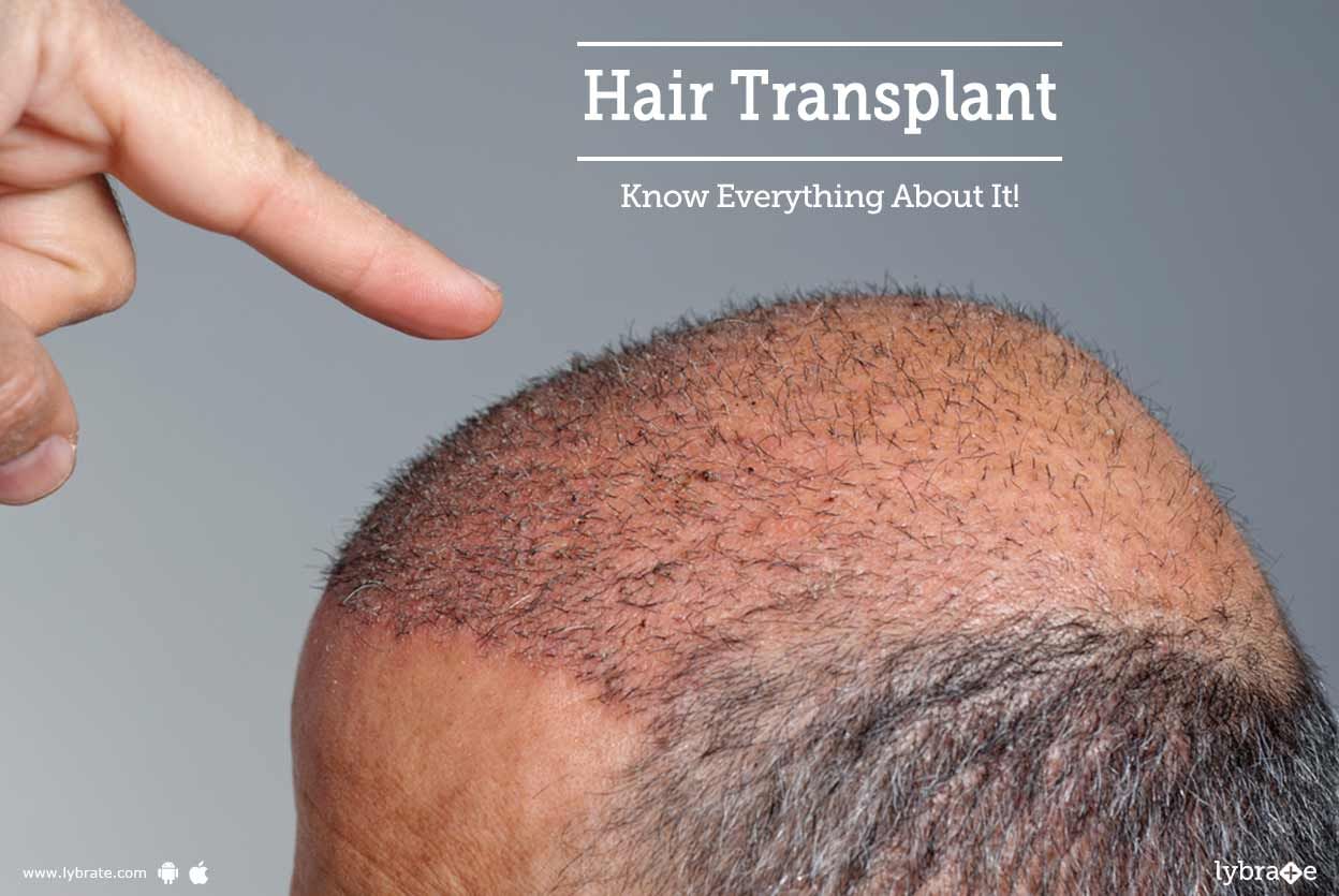 Hair Transplant - Know Everything About It!