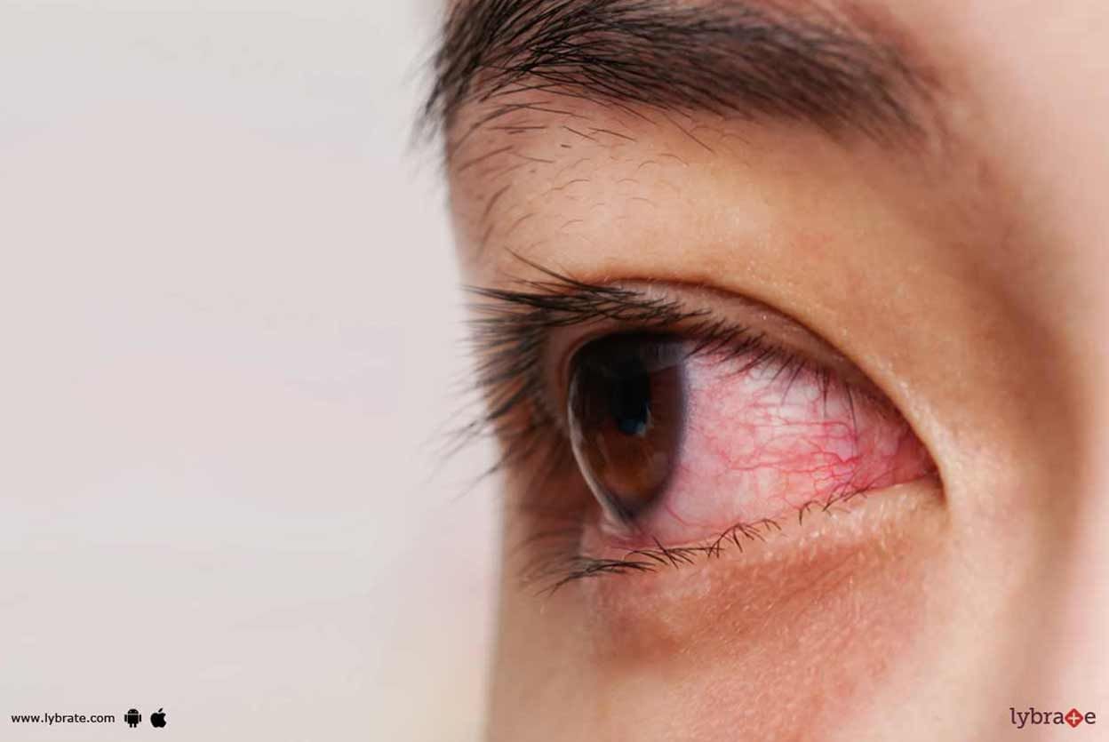Conjunctivitis - How To Administer It?