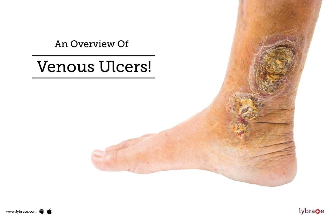 An Overview Of Venous Ulcers!