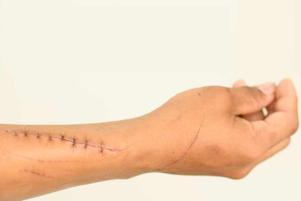How You Should Take Care of Stitches Post Surgery?