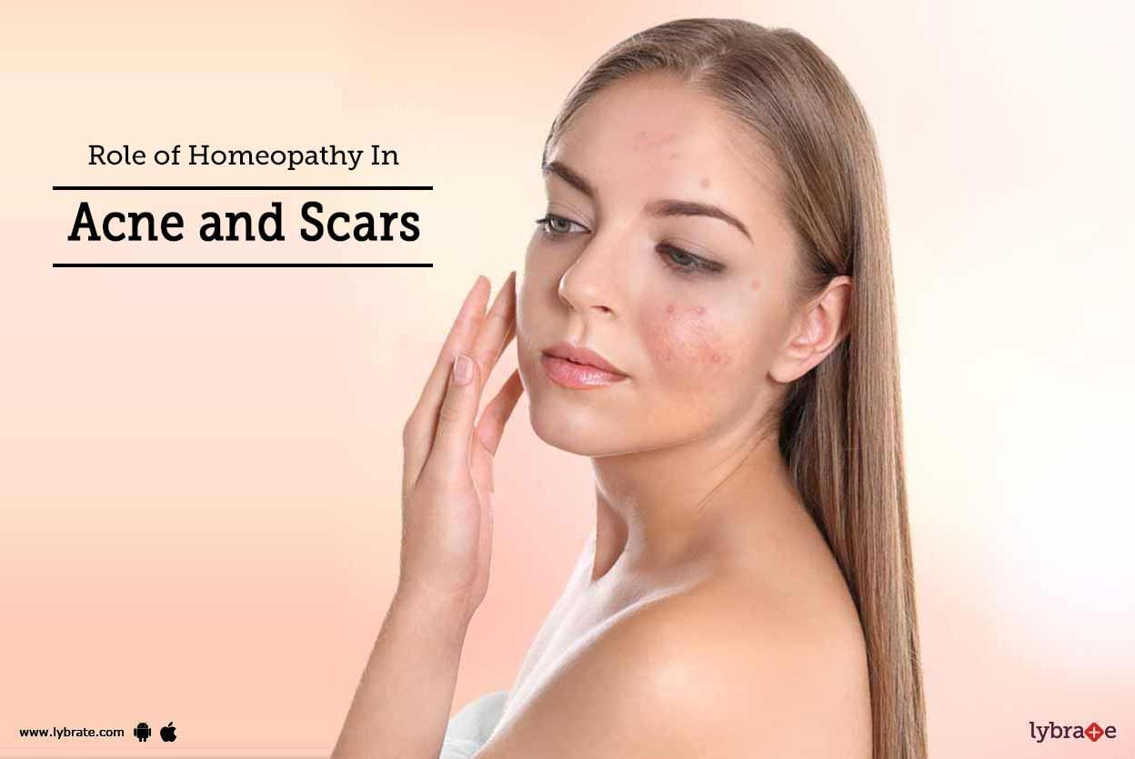 Role of Homeopathy In Acne and Scars