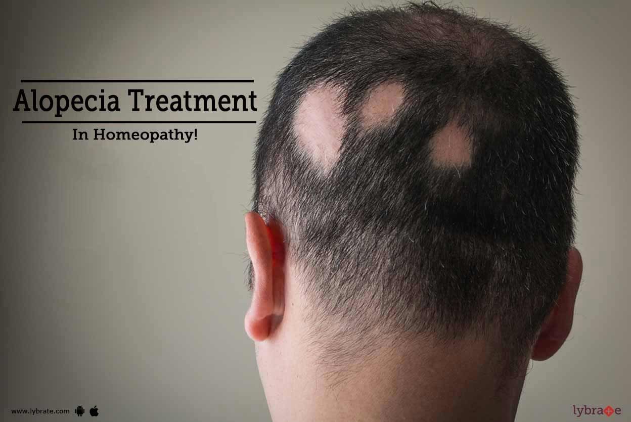 Alopecia Treatment In Homeopathy!