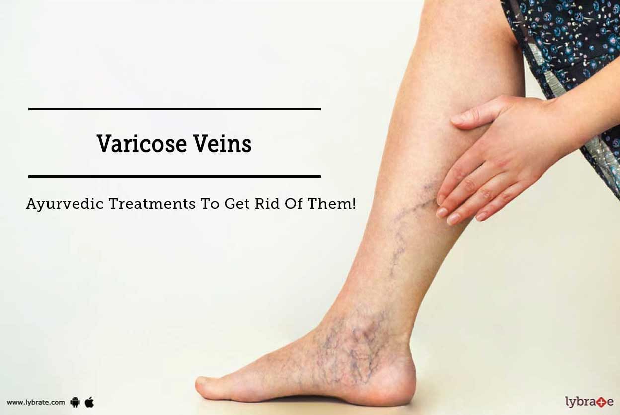 Varicose Veins - Ayurvedic Treatment To Get Rid Of Them!