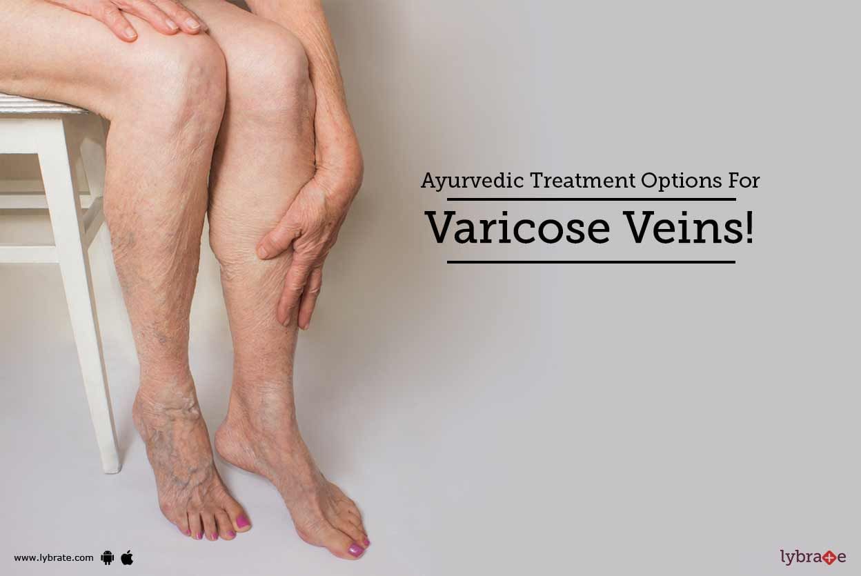 Ayurvedic Treatment Options For Varicose Veins!