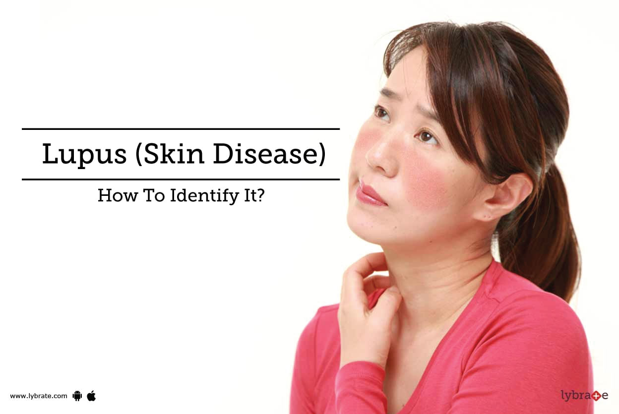 Lupus (Skin Disease) - How To Identify It?