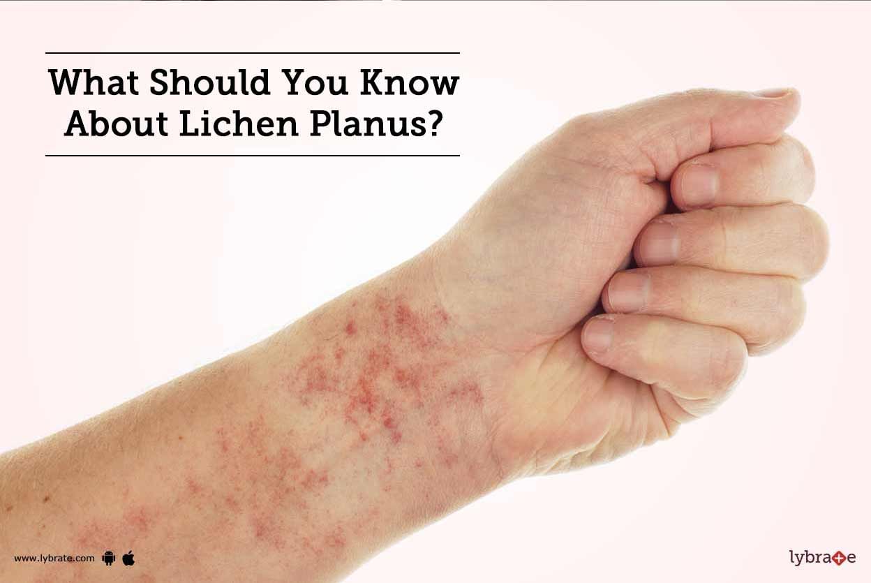 What Should You Know About Lichen Planus?