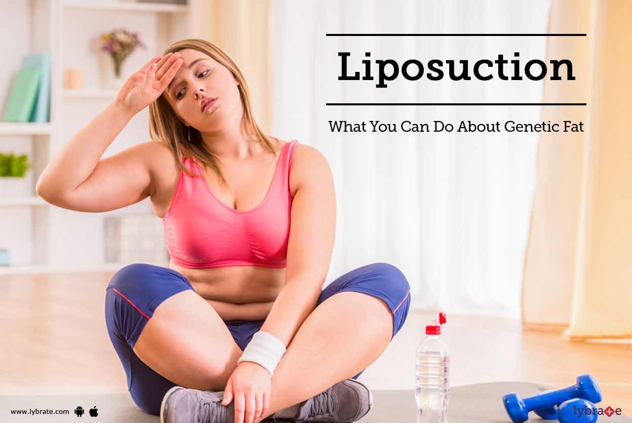 Liposuction-What You Can Do About Genetic Fat