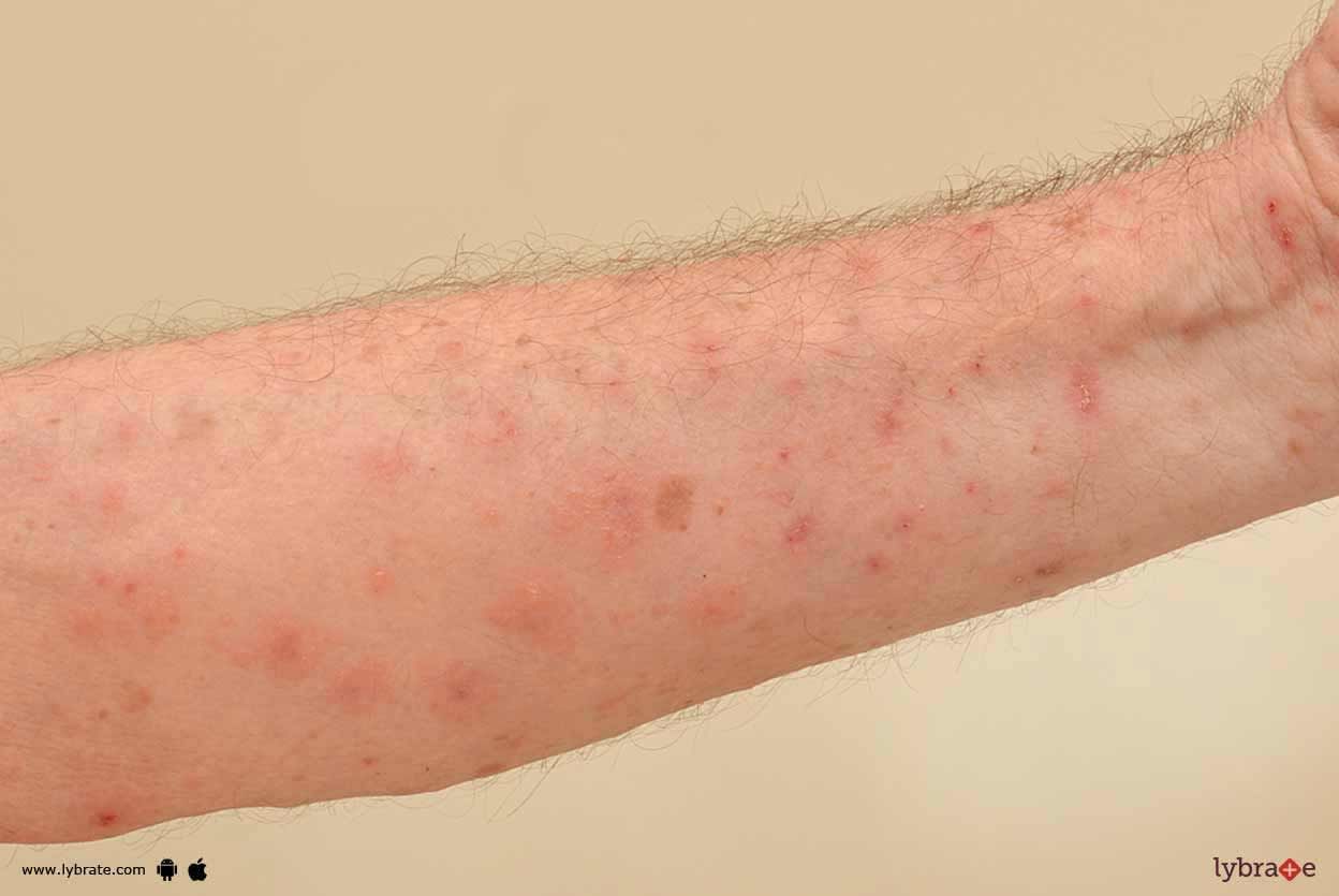 Skin Rashes - How Can Homeopathy Subdue Them?