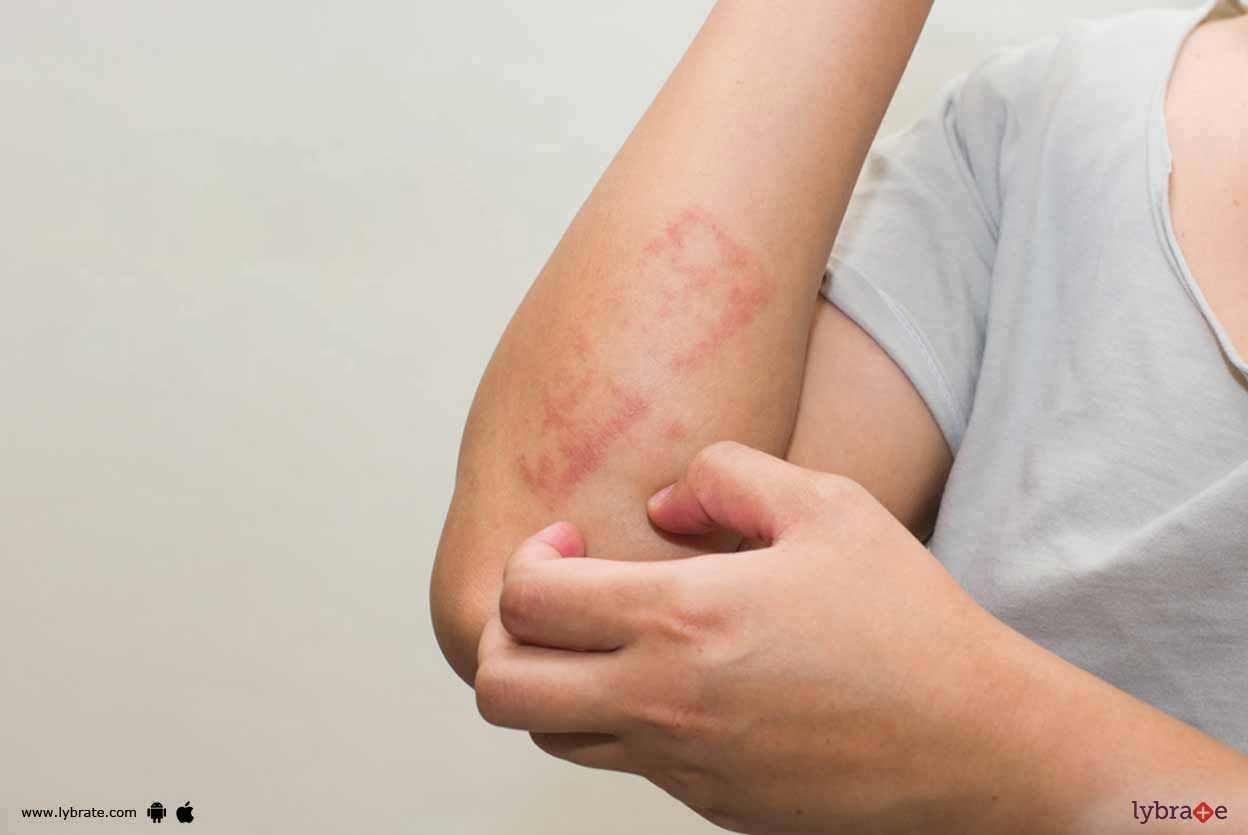 Homeopathy And Atopic Dermatitis - Know The Link!